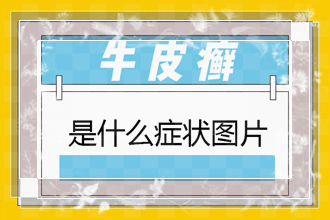 银屑病常见的病因包括哪些