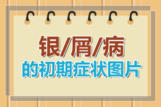 青少年为什么会患牛皮癣呢